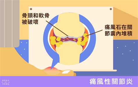 大拇指指節|為什麼會得關節炎？症狀、原因、保養關鍵